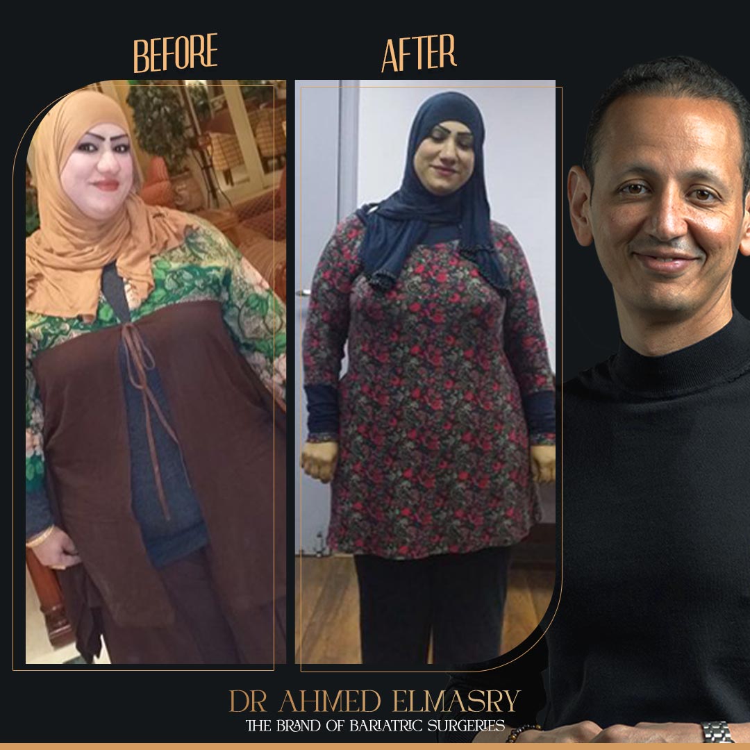 تجربتي مع تكميم المعدة